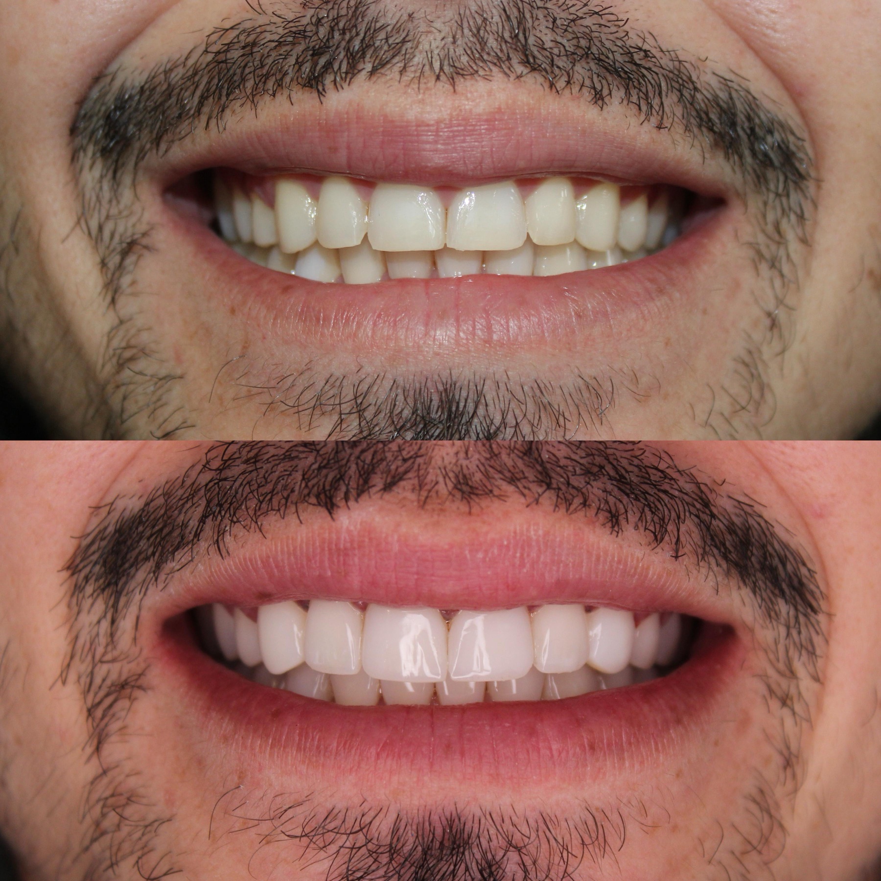 Antes e depois de clareamento dental